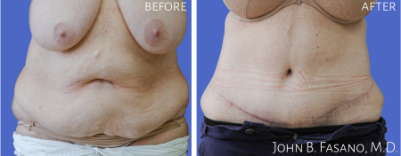 Abdominoplasty-3-022020