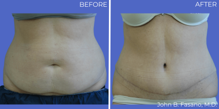 Abdominoplasty-BA-01