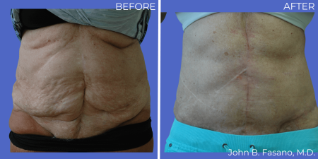 Abdominoplasty-BA-02