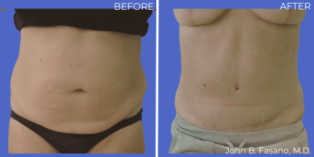 Abdominoplasty-BA-03