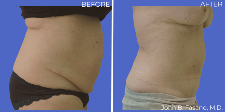 Abdominoplasty-BA-04