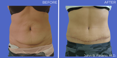 Abdominoplasty-Dr-Fasano