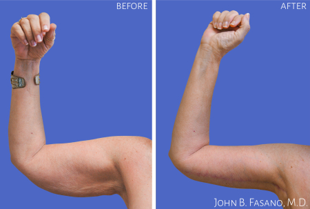 Brachioplasty-1-022020