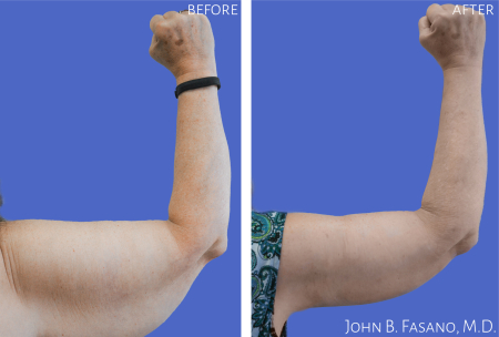 Brachioplasty-2-022020