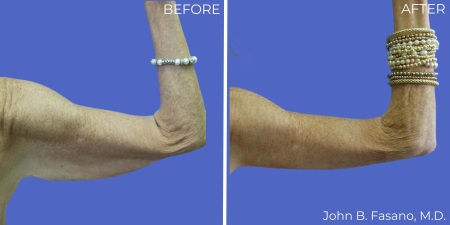 fasano-brachioplasty-before-after