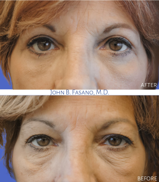 1_Bleph-upper-and-lower-022020