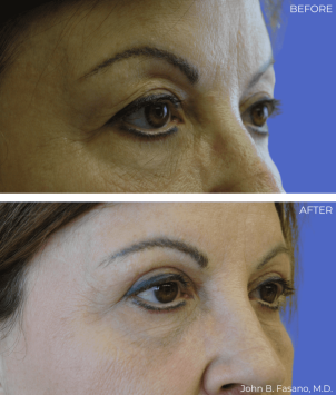 BA-Blepharoplasty-02