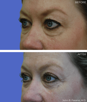 BA-Blepharoplasty-03