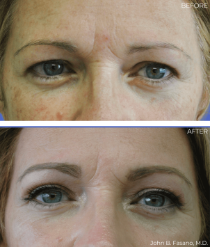 BA-Blepharoplasty-04