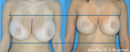 BodyTite Breast