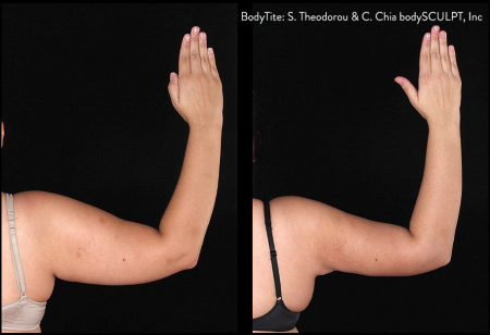BodyTite Right Arm