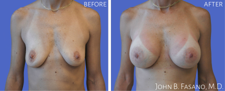 Breast-Aug-1-022020