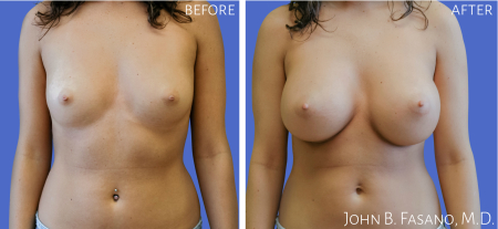 Breast-Aug-2-022020