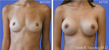 Breast-Aug-3-022020