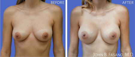 Breast-Aug-4-022020