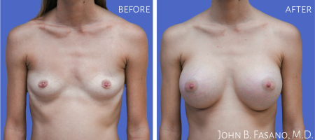 Breast-Aug-5-022020