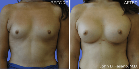 Breast-Augmentation-BA-01