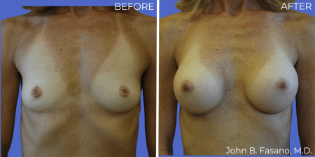 Breast-Augmentation-BA-02