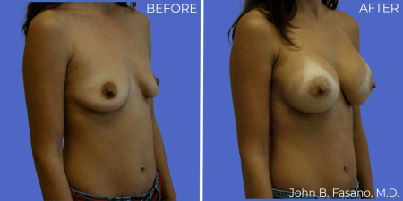 Breast-Augmentation-BA-03