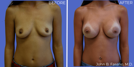 Breast-Augmentation-BA-04