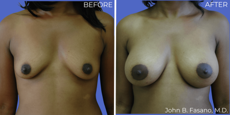 Breast-Augmentation-BA-05