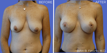 Breast-Augmentation-BA-06