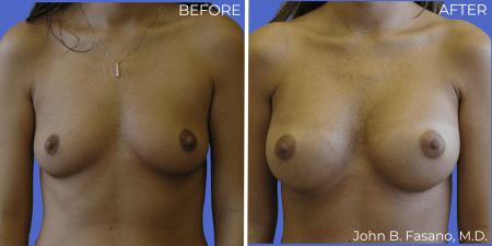 Breast-Augmentation-BA-07