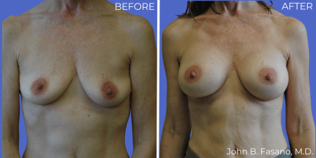 Breast-Augmentation-BA-08