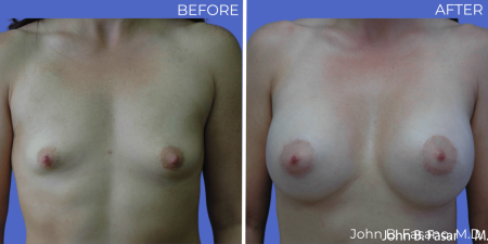 Breast-Augmentation-BA-09