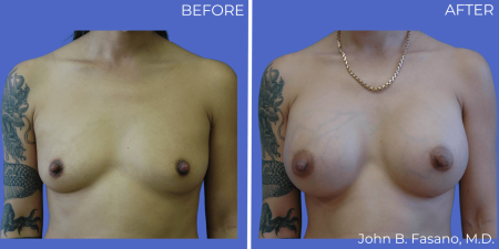 Breast-Augmentation-BA-10
