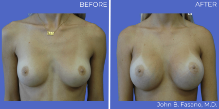 Breast-Augmentation-BA-11