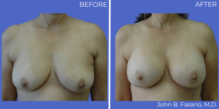 Breast-Augmentation-BA-12