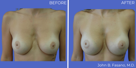 Breast-Augmentation-BA-13