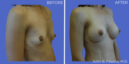 Breast-Augmentation-BA-14