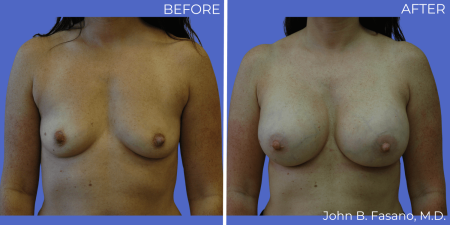 Breast-Augmentation-BA-15