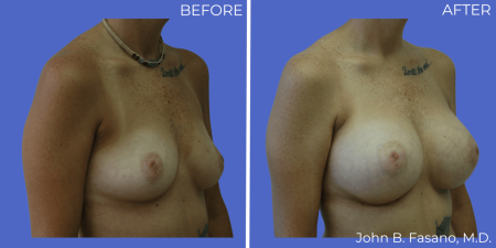 Breast-Augmentation-BA-16
