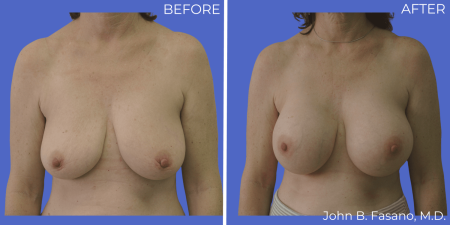 Breast-Augmentation-BA-17