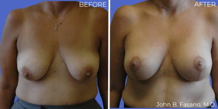 BA-Breast-Augmentation-Mastopexy-01