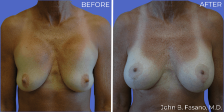 BA-Breast-Augmentation-Mastopexy-02