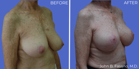 BA-Breast-Augmentation-Mastopexy-03