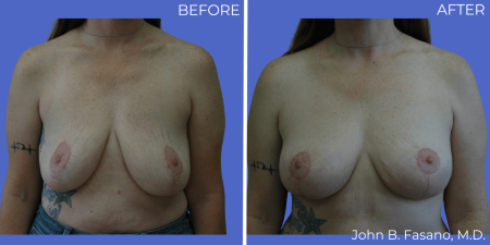 BA-Breast-Augmentation-Mastopexy-04