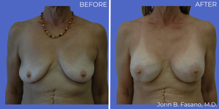 BA-Breast-Augmentation-Mastopexy-05