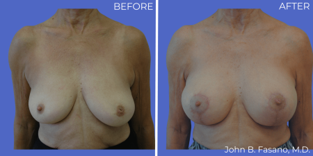 BA-Breast-Augmentation-Mastopexy-06
