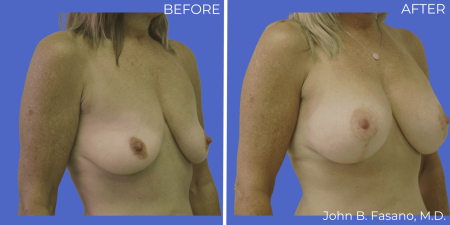 BA-Breast-Augmentation-Mastopexy-07