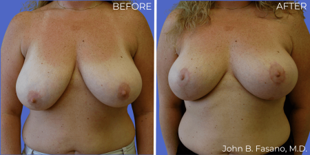 Mastopexy-BreastLift-Dr-Fasano