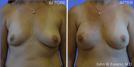 Breast-Reconstruction-BA-01