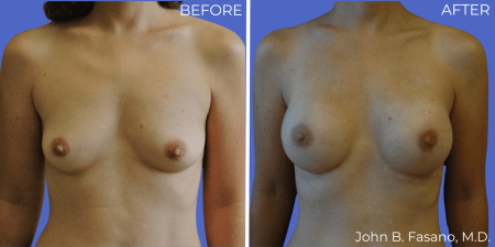 Breast-Reconstruction-BA-02