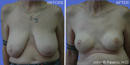 Breast-Reconstruction-BA-03