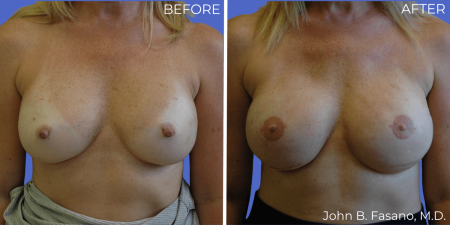 Breast-Reconstruction-BA-04