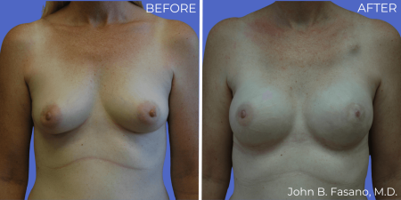 Breast-Reconstruction-BA-05